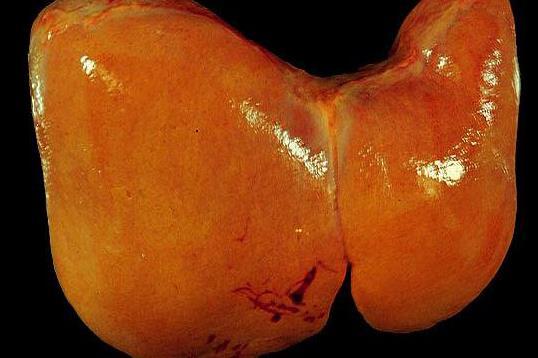 Liver steatosis