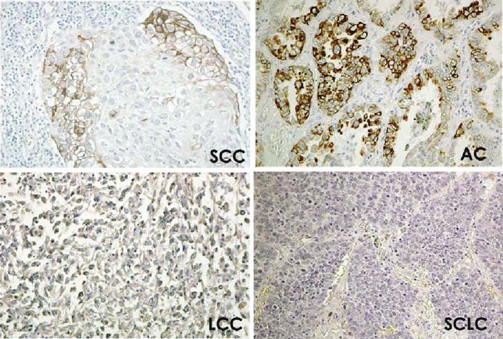 Figure 3. Immunohistochemical staining for activated mtor (p-mtor). Focally positive staining in a nest of squamous cell carcinoma (SCC).