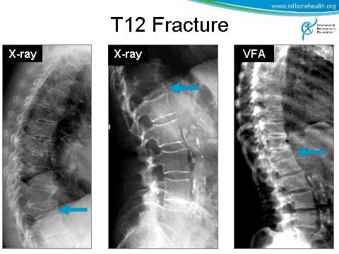 Image quality and resolution are superior with the radiograph, particularly at the upper thoracic regions (above T6 or T7) where the VFA image can suffer from interference by ribs, scapula and soft