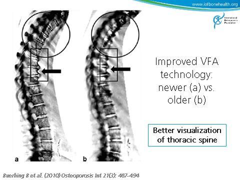 Osteoporos Int 16: 1513-1518 Slide 16, 17 These studies may underestimate the performance of VFA with the latest technologies compared to standard.