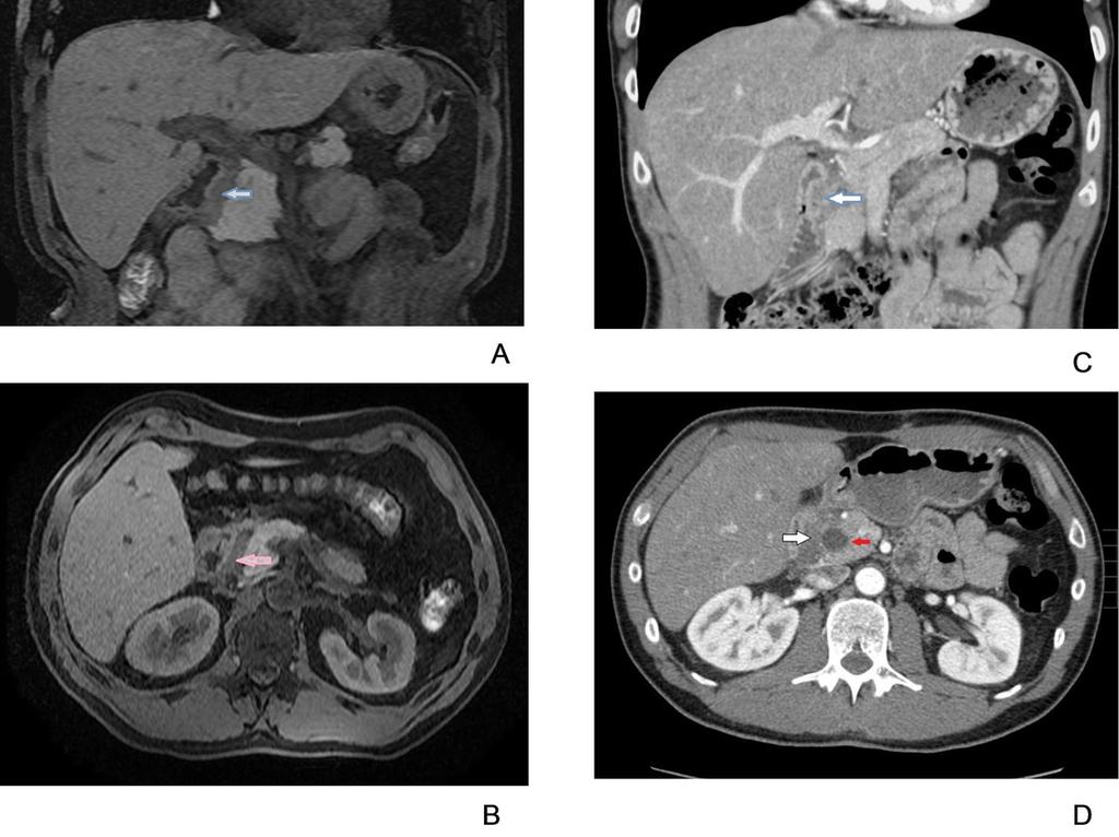 Fig. 4: 47 year old man who came to the emergency service with epigastric pain radiated into both hypochondria that has worsened over the past 15 days, although.
