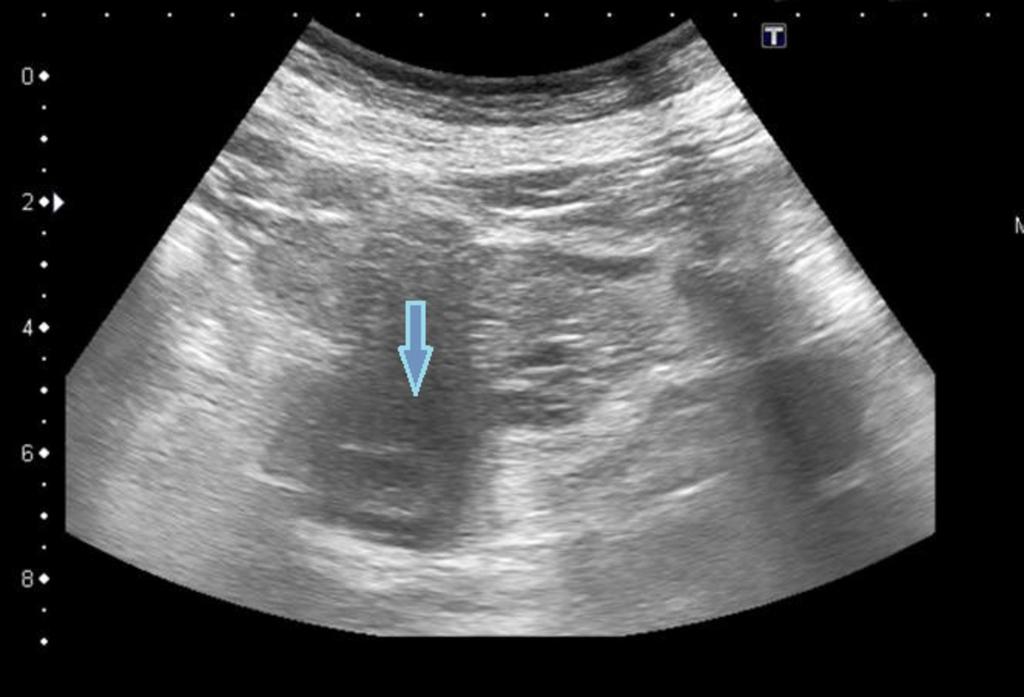 Fig. 6: Same 56 years old woman with abdominal pain in the right abdomen and the back.