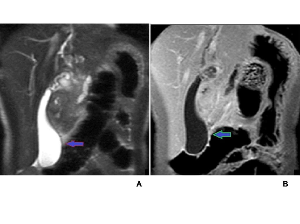 Fig. 7: Coronal single-shot fast spin-echo T2-weighted (A), and coronal fat-suppressed