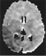 Trauma Cranial trauma produces lesions that are hyperintense on diffusion-weighted imaging, a result of cytotoxic edema (Fig. 6).
