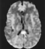 B: Axial diffusion-weighted image shows increased signal intensity in right temporal lobe (arrows) and right thalamus (arrowhead) due to cytotoxic edema.