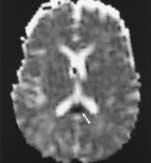 6: MRI in a 56-year-old woman with diffuse axonal injury caused by trauma following an automobile crash.