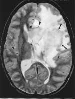 HINMAN AND PROVENZALE FIG. 7: Magnetic resonance images of a neoplasm in a 52-year-old man with glioblastoma multiforme.