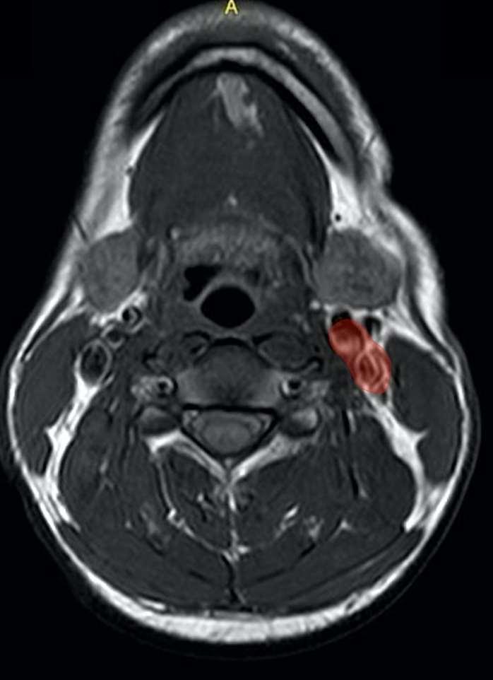 Karotiidruum Ulatub koljupõhimikust aordikaareni On ümbritsetud kõigi kolme süvafastsia kihi poolt (moodustub karotiidtupe (sheath)) Sisu: ühine karotiidarter
