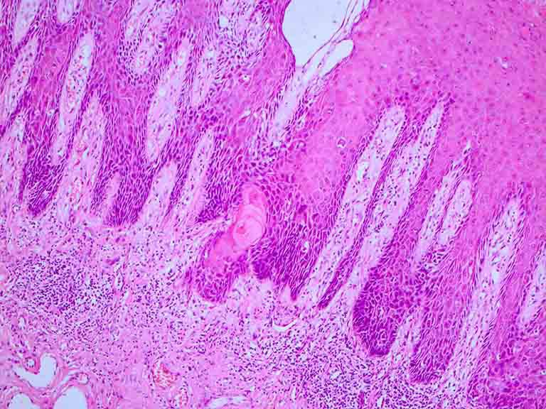 Translational Andrology and Urology, Vol 6, No 5 October 2017 805 Figure 1 Pathologic slide demonstrating undifferentiated PeIN (400 magnification). PeIN, penile intraepithelial neoplasia.