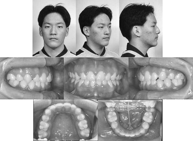 Nine months after autotransplantation, the presence of the lamina dura of the transplanted tooth was confirmed in the periapical radiograph, and active orthodontic treatment was initiated (Figure 4).