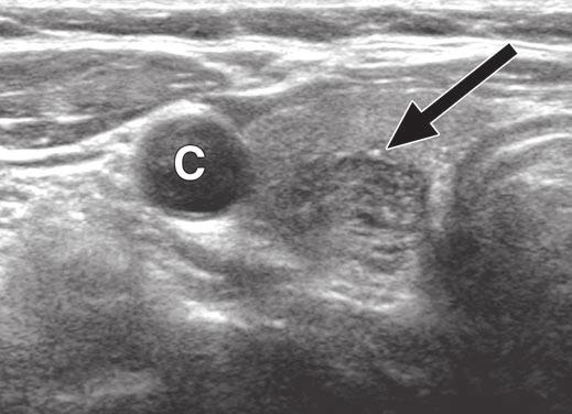 A, CT scan shows hypodense nodule (arrow) in right lobe of thyroid gland with anteroposterior transverse ratio of 1.30. c = common carotid artery, v = internal jugular vein.
