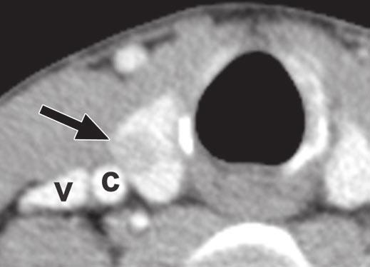 Thyroid mass with shape taller than wide on CT is compressed and transformed into wide shape on ultrasound.
