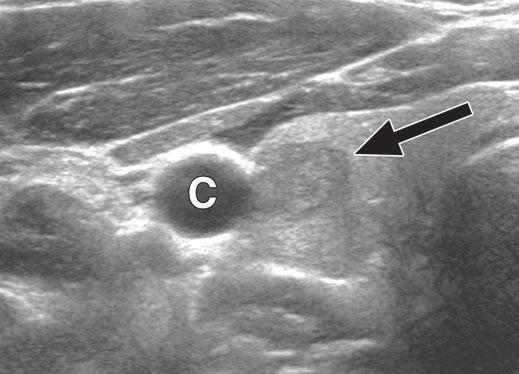 Internal jugular vein is completely collapsed on ultrasound.