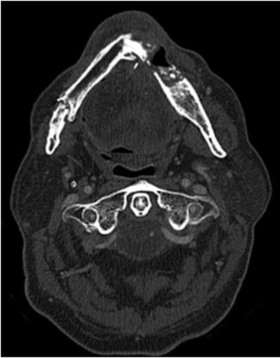 Fig. 7: CT axial imaging (bone window) of a patient with a previous mouth floor carcinoma submitted to surgery with parcial right