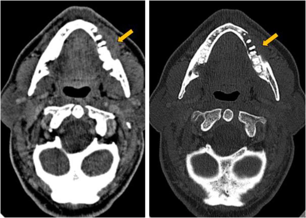 Fig. 9: Axial CT images of a patient with previous tongue cancer, with a second neoplasia in the