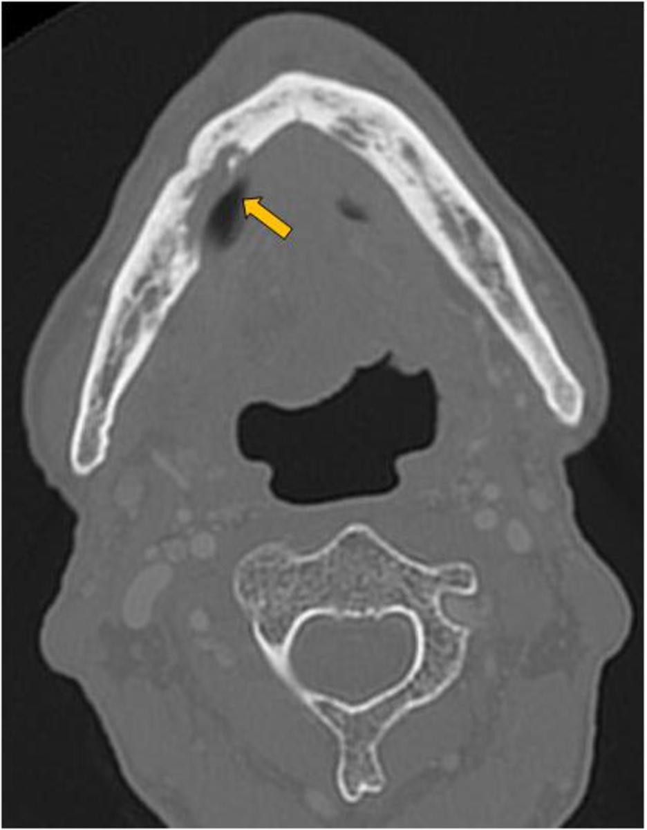 Fig. 2: Axial CT image (bone window) of patient having received RT for tongue malignancy.