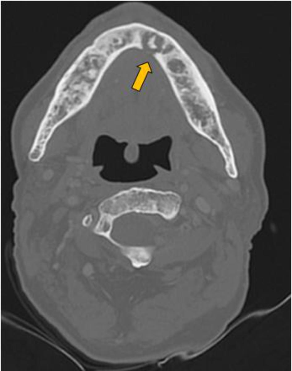 Fig. 3: Axial CT image (bone window) of a patient with a history of tongue cancer treated with surgery and RT shows