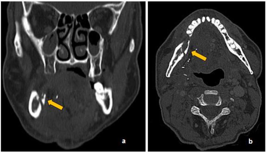 Deeply, the right ascending ramus of the mandible shows homogeneous periosteal thickening and vestibular osteolytic lesions (arrows in c and