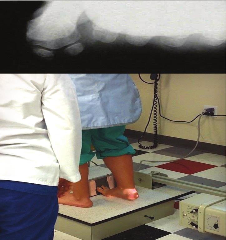 132 Continuing CME Radiographic (from page 131) be lowered by 4 from what is used for a complete foot radiograph (Figure 6).