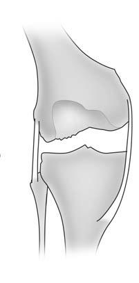 Posteromedial osteophytes may need to be removed after the proximal tibia is resected.