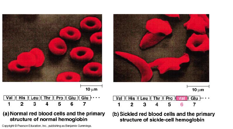 sickle cell anemia = abnormal hemoglobin develops due to a single