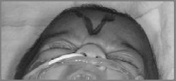 Cleft palate (unknown etiology)