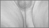 clitoris Ambiguous Genitalia Ambiguous Genitalia Mosaicism 45,X [70%]
