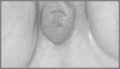 Testicular Feminization: Normal female genitalia with 46,XY karyotype