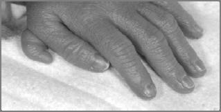 Hypoplastic finger