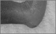foot and hypoplastic toe