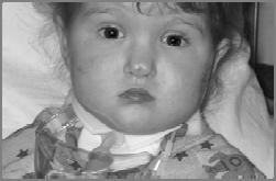 2 deletion Smith-Magenis syndrome Picked up by nurse in