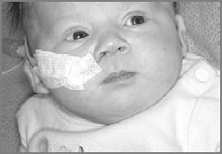 2 deletion Infantile Hypotonia Brachycephaly with flat midface