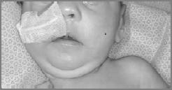 nasal tip Microcephaly Narrow