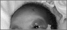 Face: Hypertelorism Face Broad nasal bridge Telecanthus Micrognathia Noonan syndrome