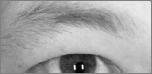 Face: Coloboma of the eyelid, malar