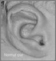 Small ear C-shaped ear 22q11.