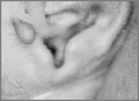 Microtia Asymmetric mouth Narrow palpebral