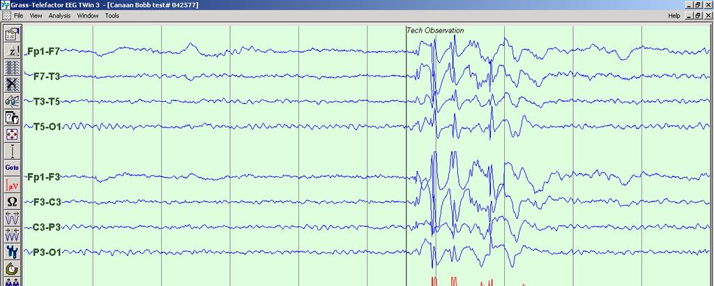 GENERALIZED SEIZURES 1 second Childhood Absence Epilepsy Diagnosis: EEG with generalized, 3 Hz spike wave Activated by Hyperventilation No indication for