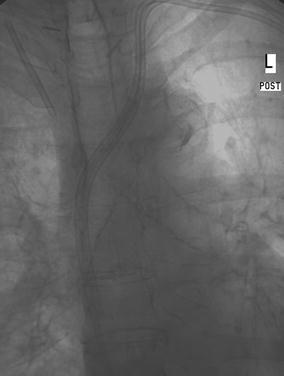 Snares Double snares (Cardiovasc IR 2007) Internal jugular & femoral sheaths IJ snare passed around