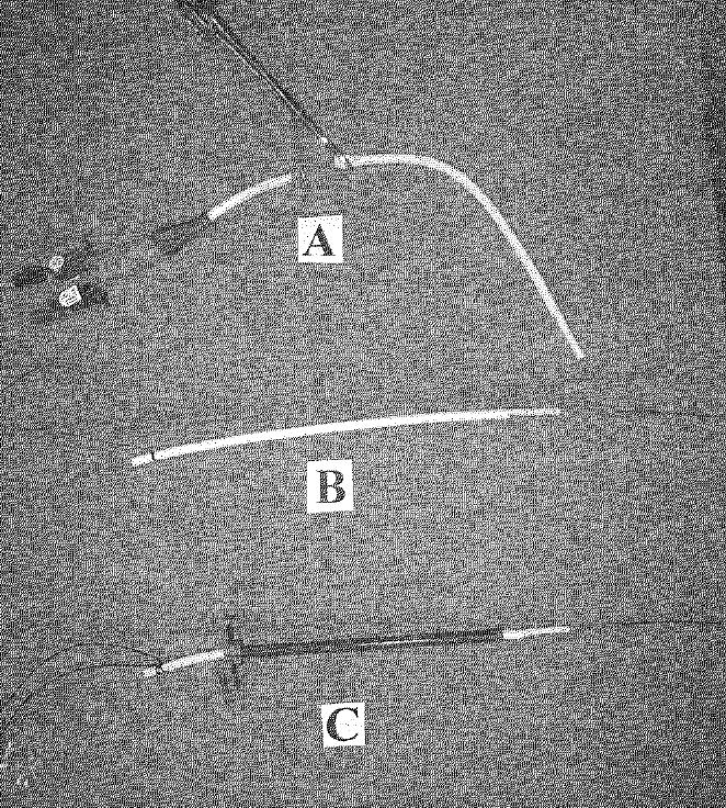 Dissection of cuff 2 nd dissection at venous entry Catheter transected Guidewire/Sheath Guidewire passed