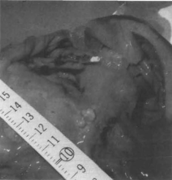 Stuck catheter - Pathology NDT 1996;11:1363 Tesio catheter 3 yr in situ Post mortem findings