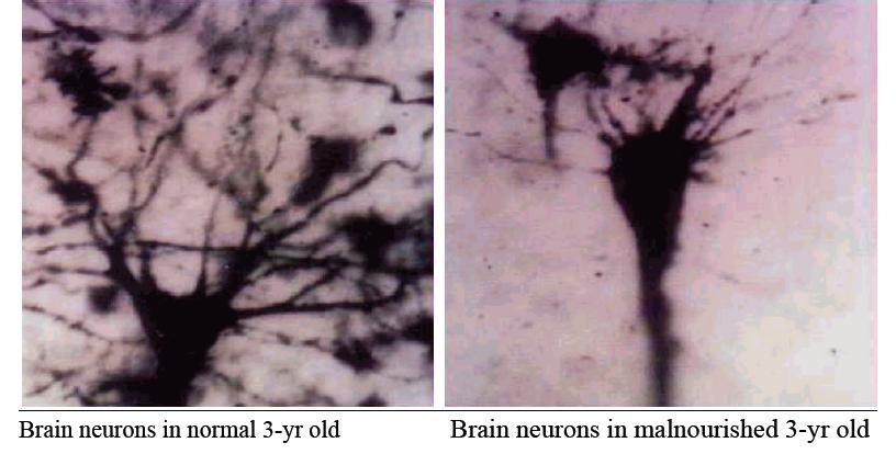 The Burden of Knowledge Brain neurons in normal 3-yr old Brain neurons in malnourished