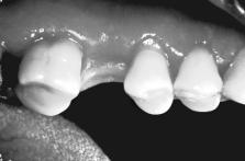 For oral hygiene accessibility, the abutment should be placed about 1 to 2 mm above the surrounding mucosa. Two weeks later, the final prosthodontic treatment may begin.