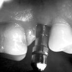 Fig 3 Successive enlargement of the implant site with a twist drill under profuse saline irrigation.