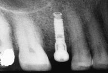 Table 1 Results of 20 Implants Placed with a One-Step Method Criteria for clinical evaluation Presistent pain, Periodontal infection, Time since Time since Healing probing Radiolucency Mobility