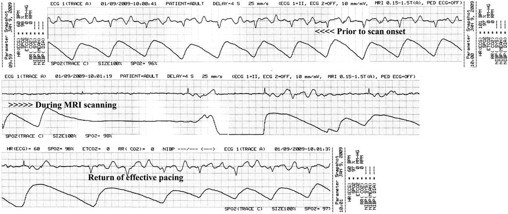 Patient Safety An toàn bệnh nhân 9 GIMBEL, J. R., (2009): Return of effective pacing after discontinuation of gradient field application.