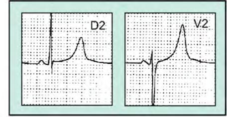 EKG značilnosti LQT1,2,3 LQT1: