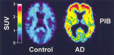 Impact of Alzheimer s Treatment 14 12 10 8 6 Delay onset by 2 years 2003 2010 2020 2030 2040 2050 Memory and Aging Center year Delay onset by 5 years 300 200 100 Cost to