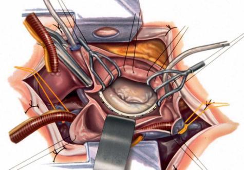 Anuloplastia mitrala In ciuda evidentelor legate de rolul chirurgiei in tratamentul regurgitarii mitrale din insuficienta cardiaca, studii retrospective recente nu au demonstrat o scadere in