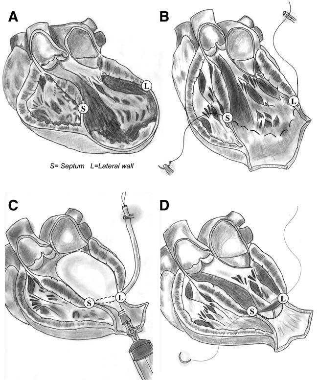 Left ventricular reconstruction. (A) Antero-septoapical aneurysm. (B) Endoventricular purse-string suture.